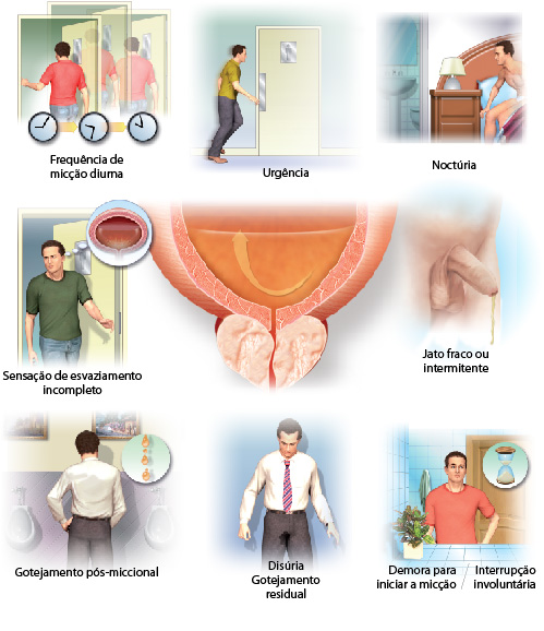 hipertrofia prostatica grado 1 sintomas