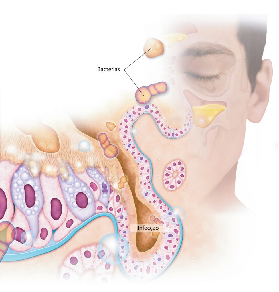 Como saber se estou ou não com sinusite bacteriana?